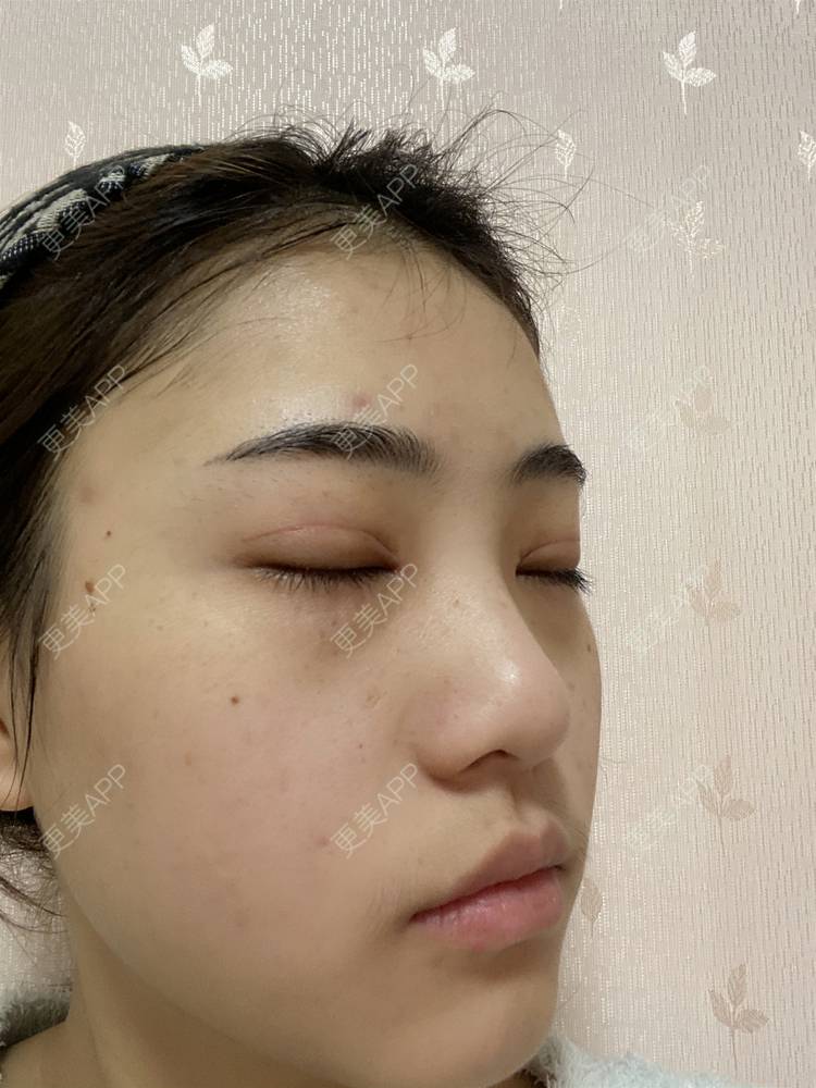 更美 - 鲸落鲸起的全切双眼皮经验 | 全切双眼皮 | 开内眼角 | 开外眼角 | 眼睑下至 | 重庆