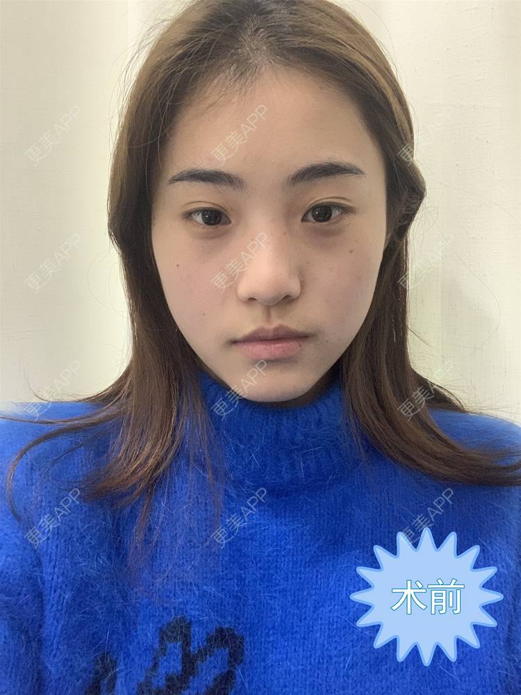 更美 - 鲸落鲸起的全切双眼皮经验 | 全切双眼皮 | 开内眼角 | 开外眼角 | 眼睑下至 | 眼部多项 | 重庆