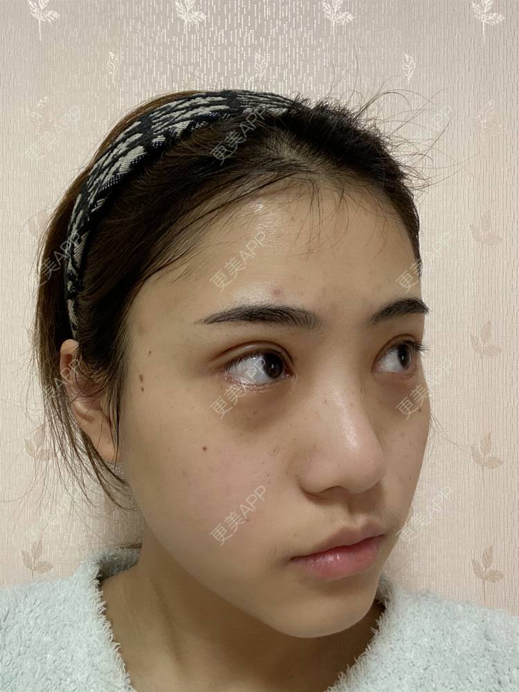 更美 - 鲸落鲸起的全切双眼皮经验 | 全切双眼皮 | 开内眼角 | 开外眼角 | 眼睑下至 | 眼部多项 | 重庆