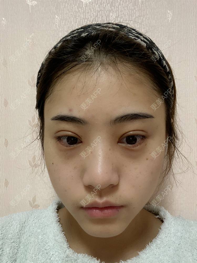 更美 - 鲸落鲸起的全切双眼皮经验 | 全切双眼皮 | 开内眼角 | 开外眼角 | 眼睑下至 | 眼部多项 | 重庆