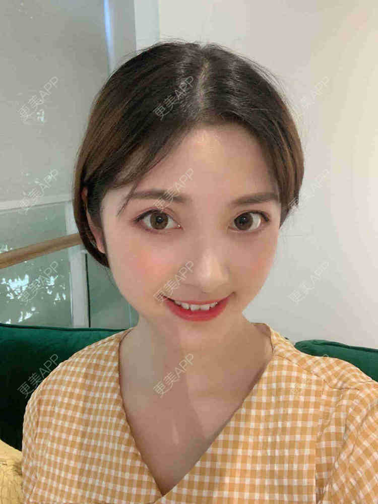 更美 - 安静的粥的自体脂肪全面部填充经验 | 自体脂肪全面部填充 | 视频日记 | 重庆