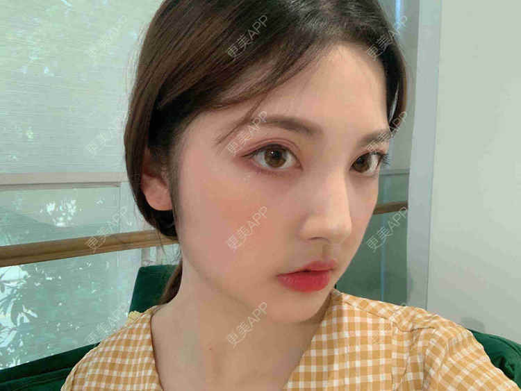 更美 - 安静的粥的自体脂肪全面部填充经验 | 自体脂肪全面部填充 | 视频日记 | 重庆