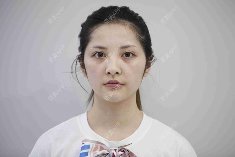 更美 - 安静的粥的自体脂肪全面部填充经验 | 自体脂肪全面部填充 | 视频日记 | 重庆