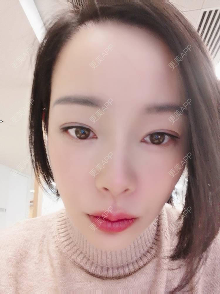 更美 - 🐷🐮仔仔仔的热玛吉经验 | 上海 | 热玛吉
