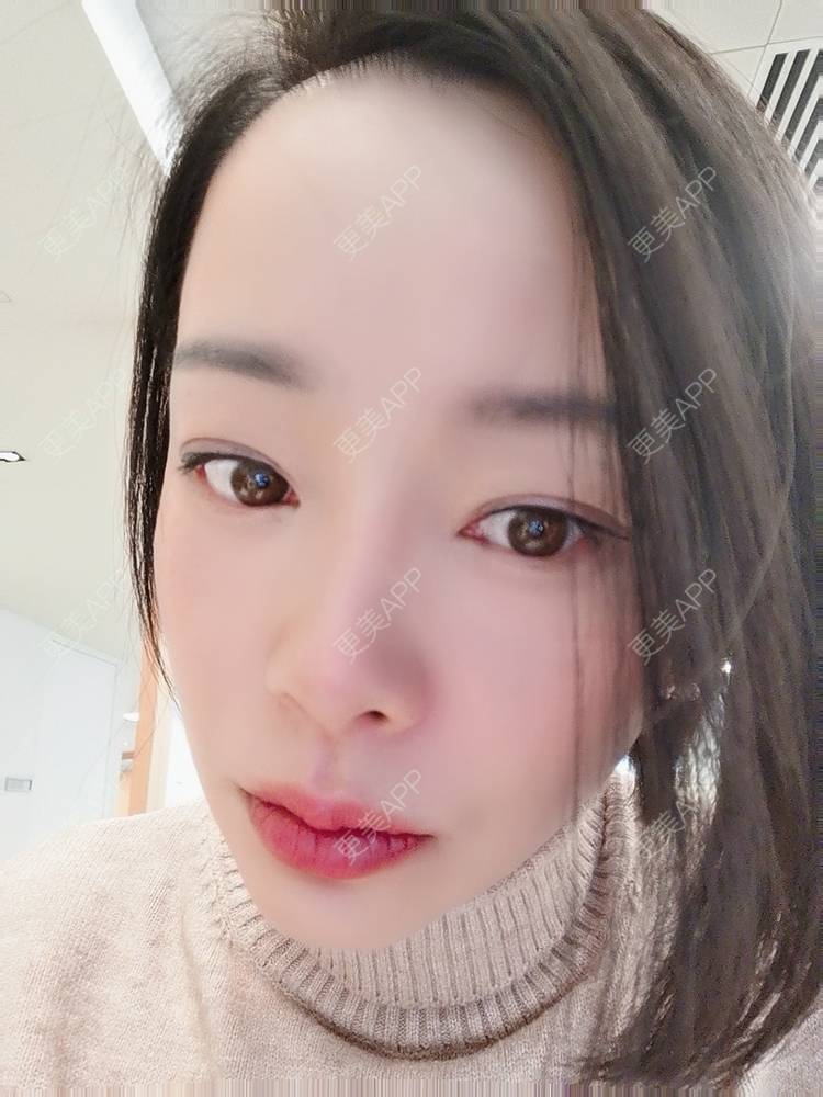 更美 - 🐷🐮仔仔仔的热玛吉经验 | 上海 | 热玛吉