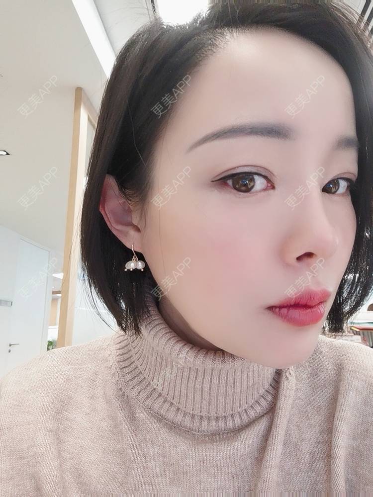 更美 - 🐷🐮仔仔仔的热玛吉经验 | 上海 | 热玛吉
