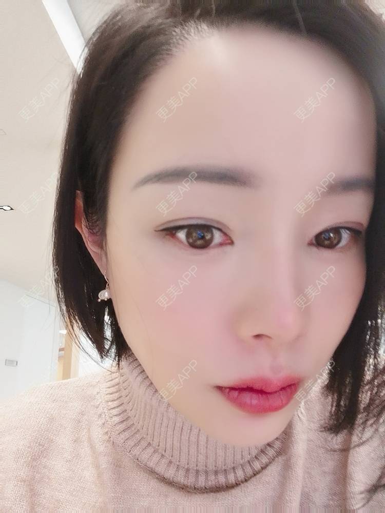 更美 - 🐷🐮仔仔仔的热玛吉经验 | 上海 | 热玛吉
