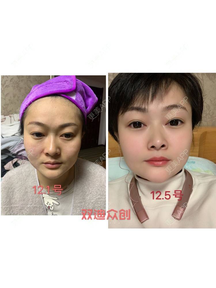 更美 - 高科技无针雾化抗衰-的除皱经验 | 除皱 | 埋线提升 | 祛皱 | 除皱套餐 | 潍坊