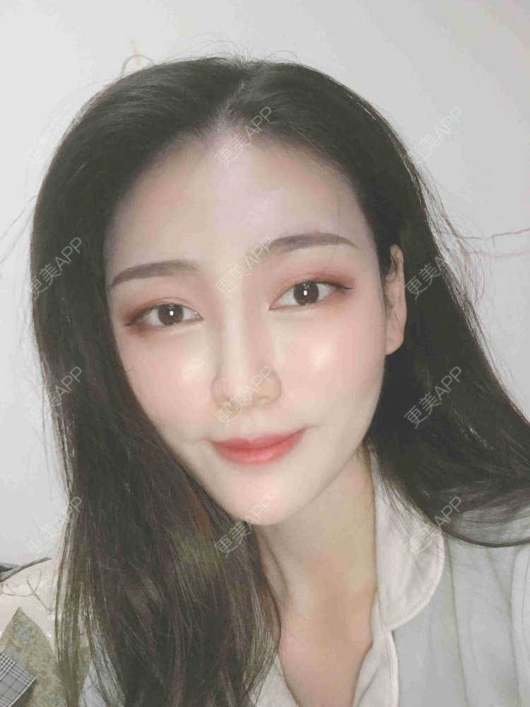 更美 - 芝麻芝麻开开门的自体脂肪全面部填充经验 | 自体脂肪全面部填充 | 视频日记 | 重庆
