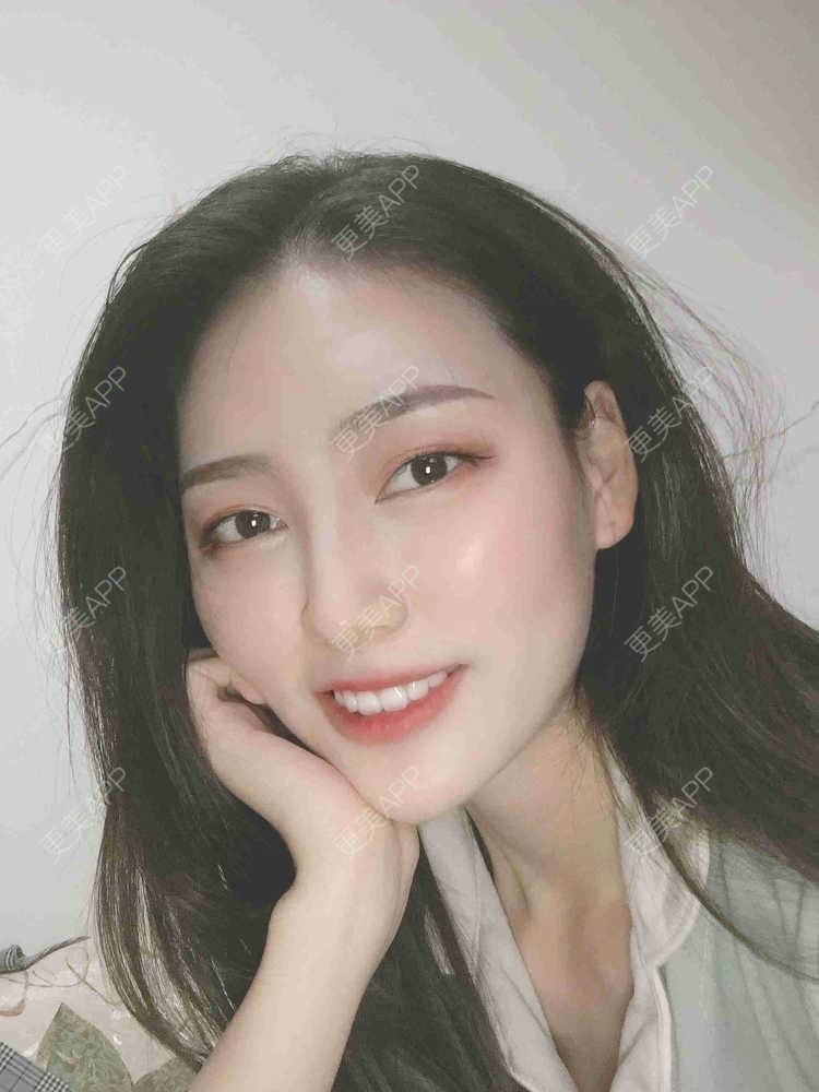 更美 - 芝麻芝麻开开门的自体脂肪全面部填充经验 | 自体脂肪全面部填充 | 视频日记 | 重庆