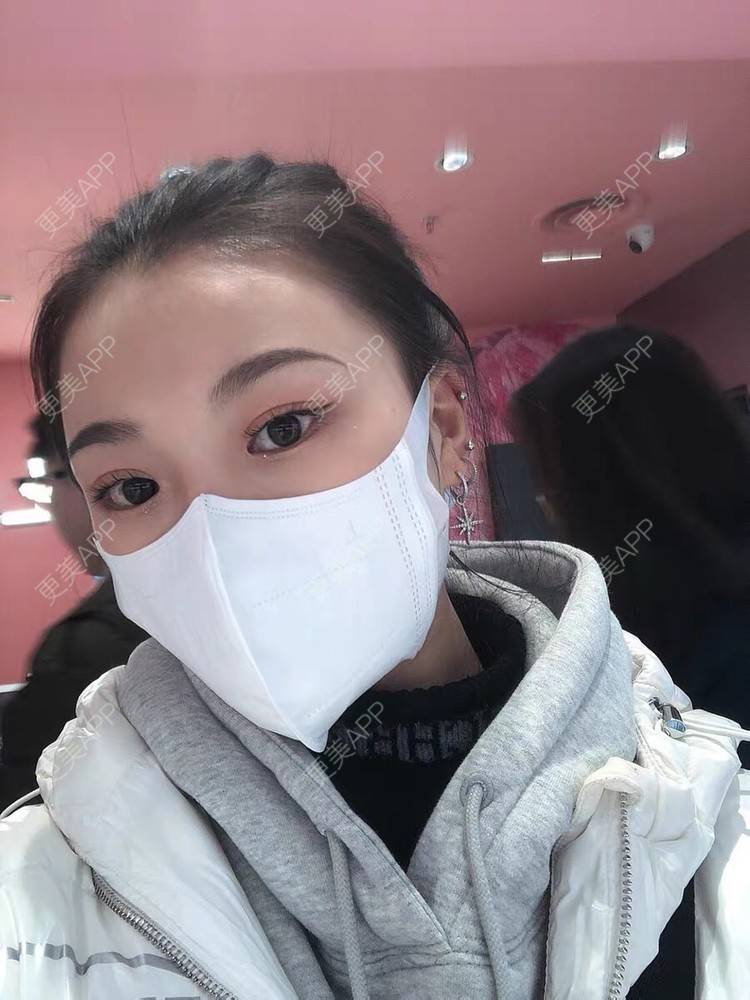 更美 - 更美用户DtEcDqa1aZ的乳头缩小经验 | 乳头缩小