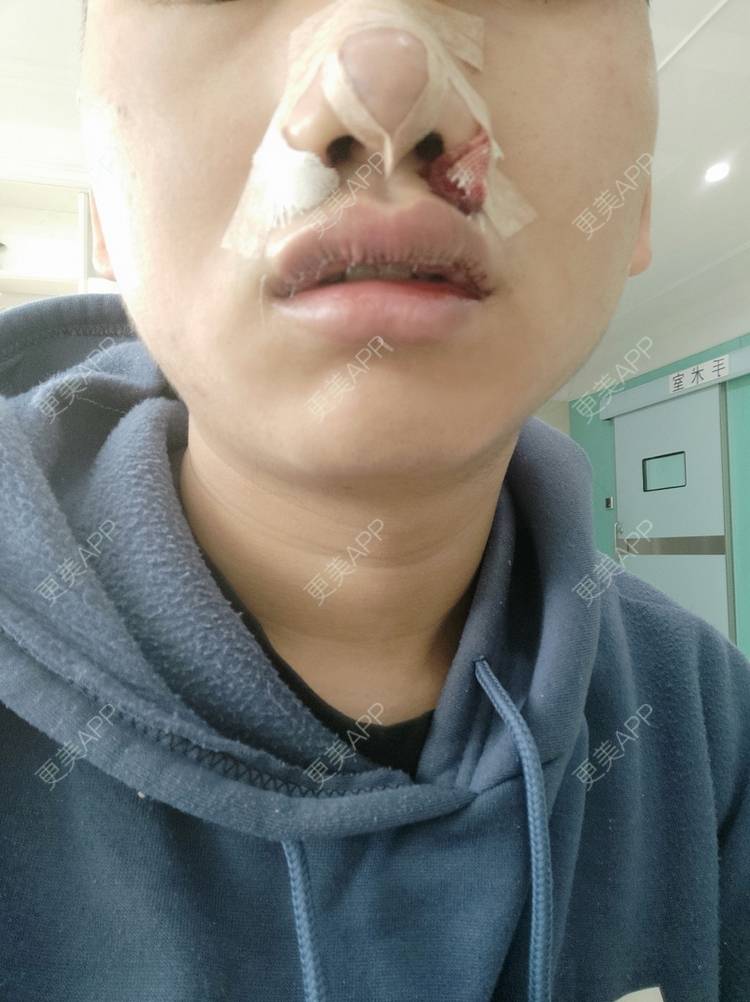 更美 - 更美用户Dc0uLvMdeZ的手术缩鼻头经验 | 手术缩鼻头 | 鼻翼缩小 | 佛山