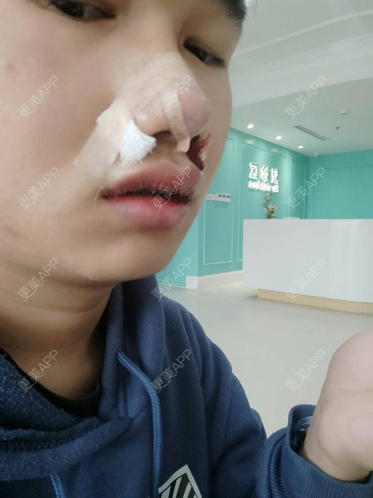 更美 - 更美用户Dc0uLvMdeZ的手术缩鼻头经验 | 手术缩鼻头 | 鼻翼缩小 | 佛山