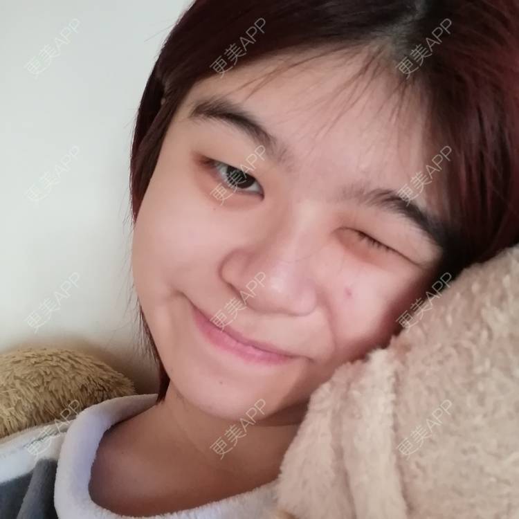 更美 - 一伊要变好看的玻尿酸卧蚕经验 | 玻尿酸卧蚕 | 玻尿酸泪沟 | 玻尿酸唇部 | 北京
