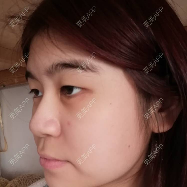 更美 - 一伊要变好看的玻尿酸泪沟经验 | 玻尿酸泪沟 | 北京