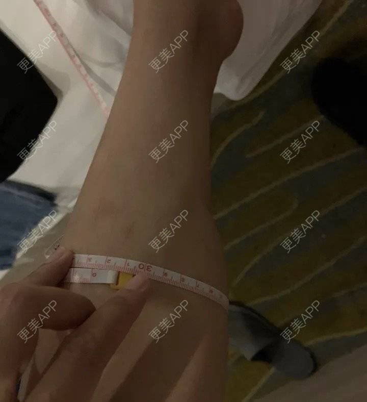 更美 - 更美用户BYgsCmMczy的注射塑形腿部经验 | 注射塑形腿部 | 广州