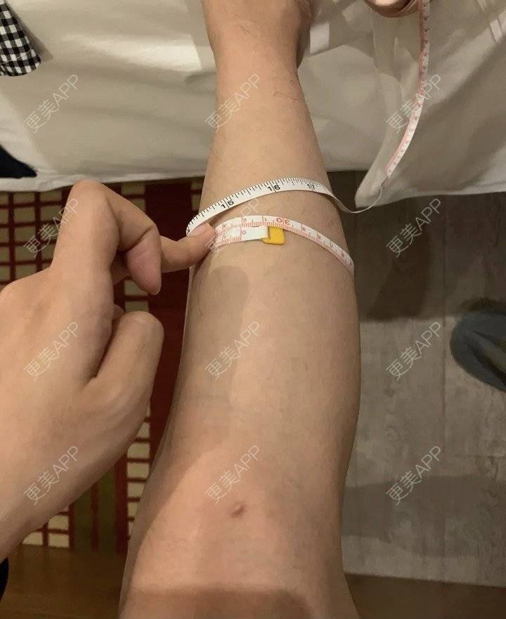 更美 - 更美用户BYgsCmMczy的注射塑形腿部经验 | 注射塑形腿部 | 广州