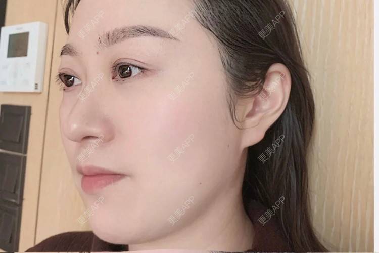 更美 - 更美用户7XGlnjvrvL的射频提升经验 | 射频提升 | 沈阳