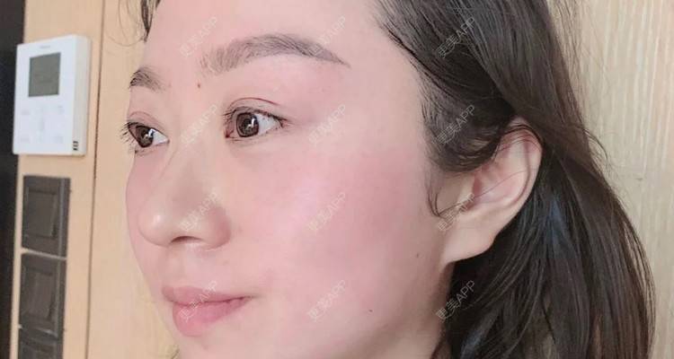 更美 - 更美用户7XGlnjvrvL的射频提升经验 | 射频提升 | 沈阳