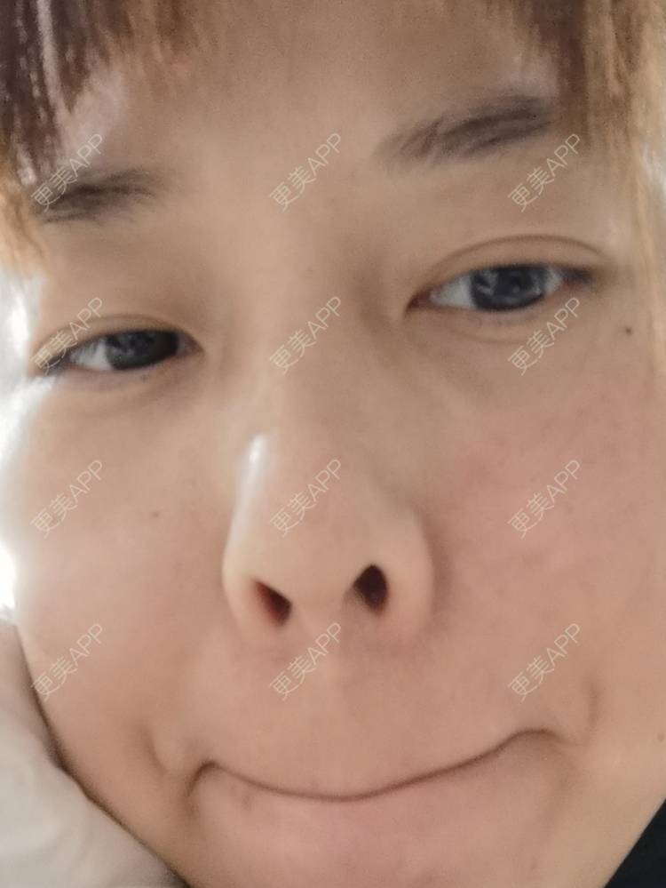 更美 - 更美用户YTQF3Vhay4的自体脂肪丰苹果肌经验 | 自体脂肪全面部填充 | 自体脂肪丰太阳穴 | 自体脂肪丰苹果肌 | 自体脂肪丰面颊 | 自体脂肪丰额头 | 重庆