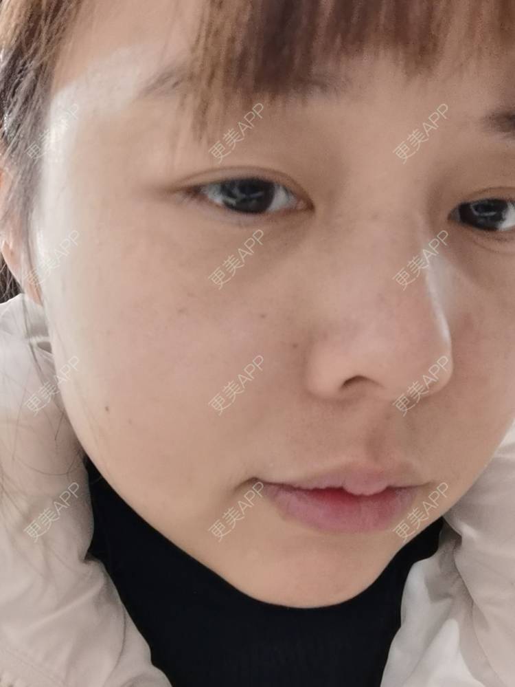 更美 - 更美用户YTQF3Vhay4的自体脂肪丰苹果肌经验 | 自体脂肪全面部填充 | 自体脂肪丰太阳穴 | 自体脂肪丰苹果肌 | 自体脂肪丰面颊 | 自体脂肪丰额头 | 重庆