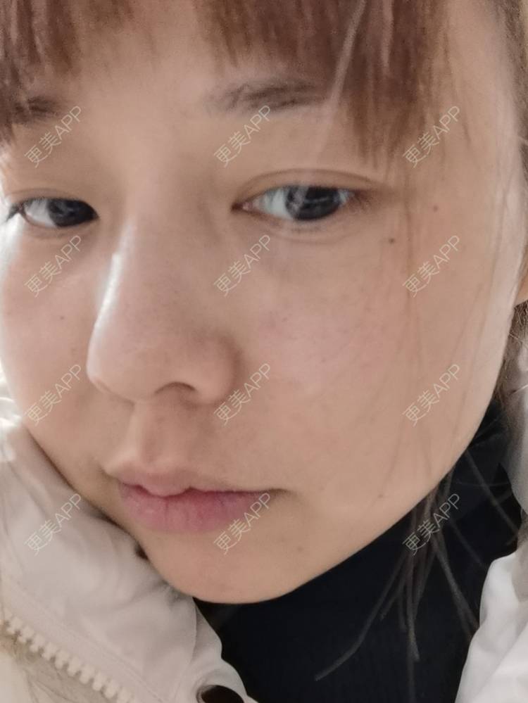 更美 - 更美用户YTQF3Vhay4的自体脂肪丰苹果肌经验 | 自体脂肪全面部填充 | 自体脂肪丰太阳穴 | 自体脂肪丰苹果肌 | 自体脂肪丰面颊 | 自体脂肪丰额头 | 重庆