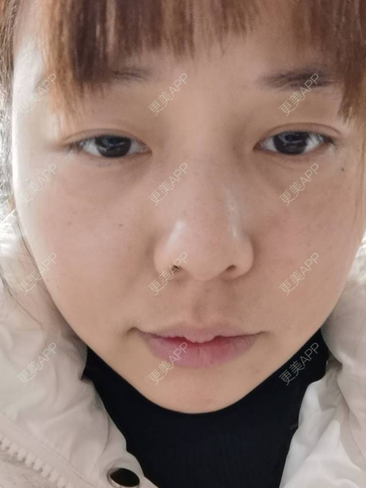 更美 - 更美用户YTQF3Vhay4的自体脂肪丰苹果肌经验 | 自体脂肪全面部填充 | 自体脂肪丰太阳穴 | 自体脂肪丰苹果肌 | 自体脂肪丰面颊 | 自体脂肪丰额头 | 重庆
