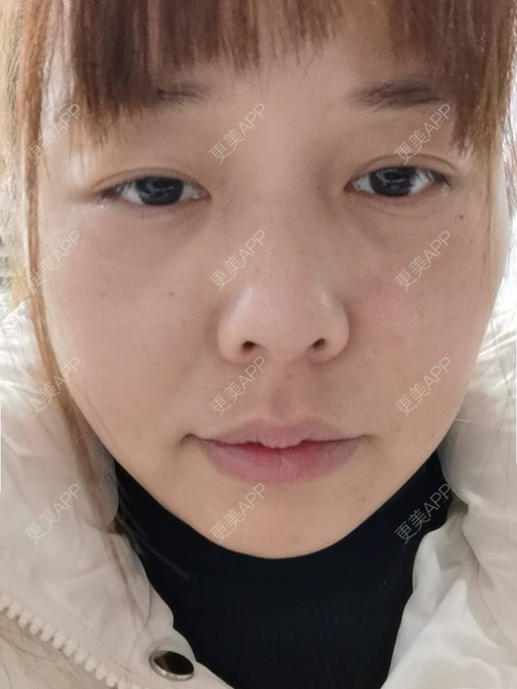 更美 - 更美用户YTQF3Vhay4的自体脂肪丰苹果肌经验 | 自体脂肪全面部填充 | 自体脂肪丰太阳穴 | 自体脂肪丰苹果肌 | 自体脂肪丰面颊 | 自体脂肪丰额头 | 重庆