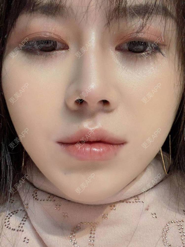 更美 - 更美欢的唇腭裂修复经验 | M唇成形 | 微笑唇手术 | 唇综合 | 厚唇改薄 | 唇腭裂修复 | 唇形