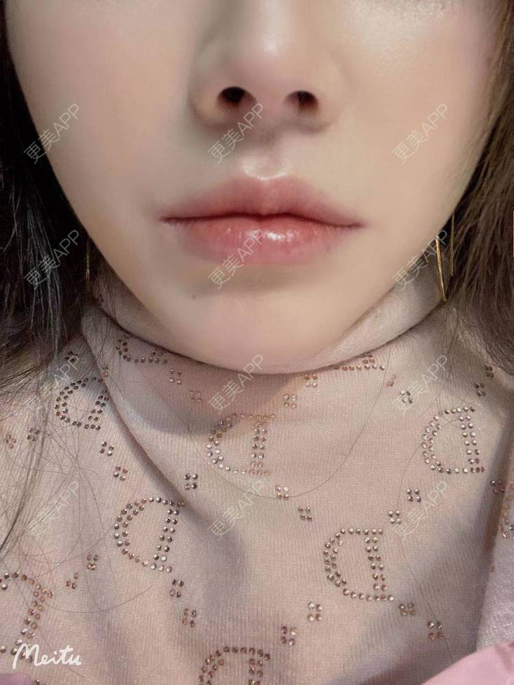 更美 - 更美欢的唇腭裂修复经验 | M唇成形 | 微笑唇手术 | 唇综合 | 厚唇改薄 | 唇腭裂修复 | 唇形