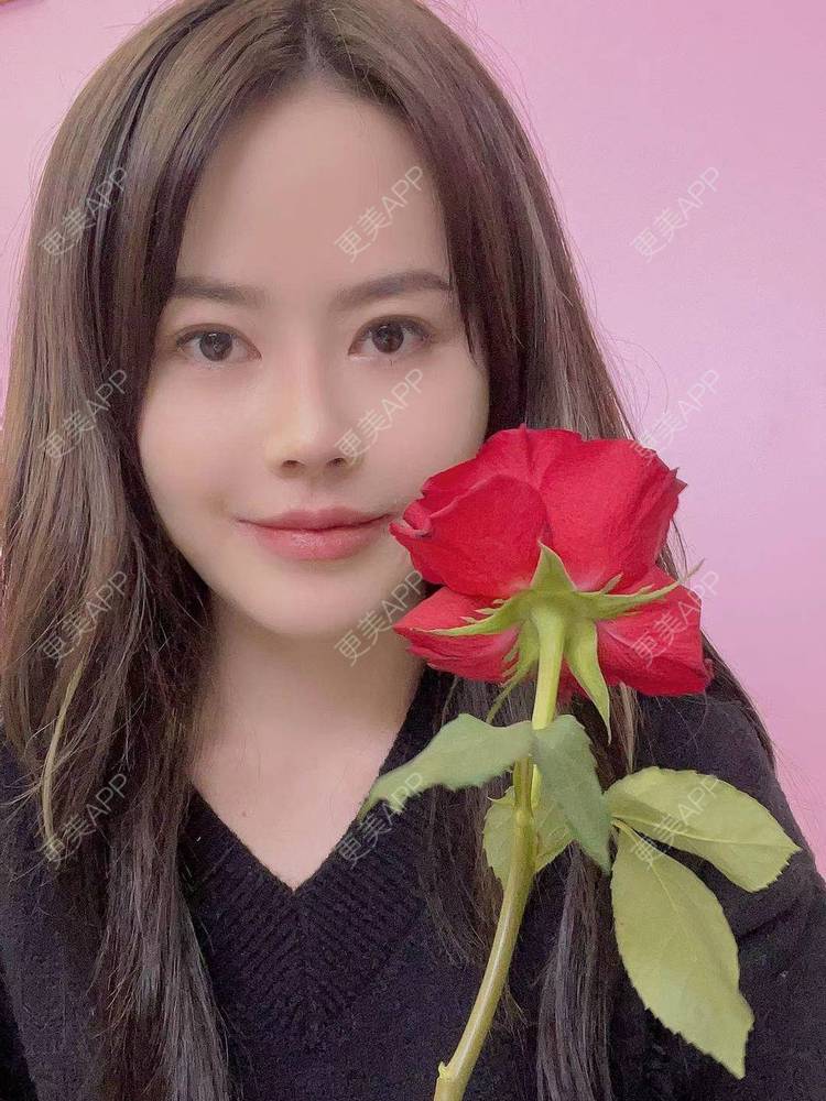 更美 - 更美欢的唇腭裂修复经验 | M唇成形 | 微笑唇手术 | 唇综合 | 厚唇改薄 | 唇腭裂修复 | 唇形