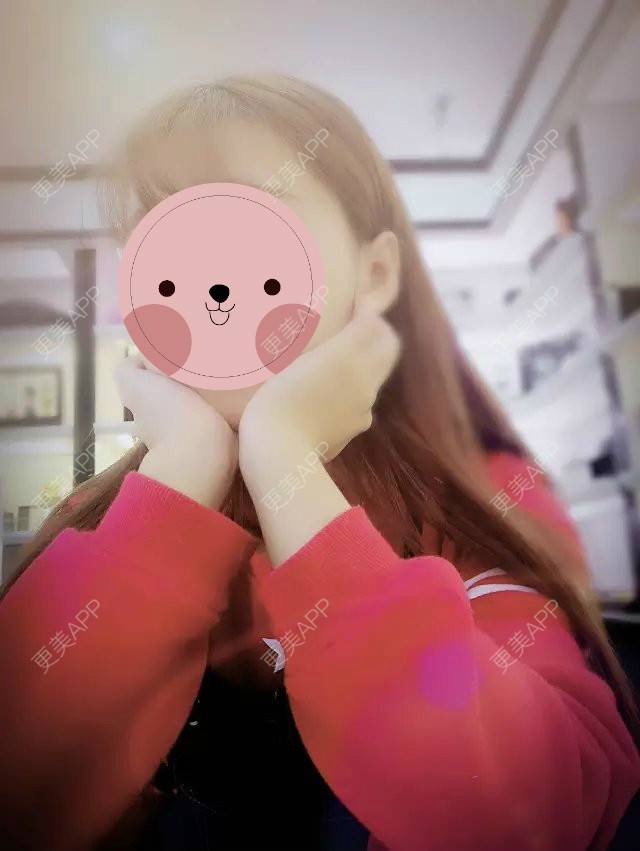 更美 - 喜新恋旧。故的阴唇整形经验 | 上海 | 阴唇整形