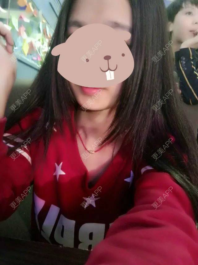 更美 - 喜新恋旧。故的阴唇整形经验 | 上海 | 阴唇整形