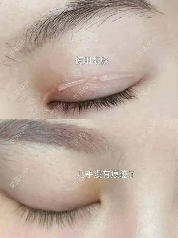 更美 - 可可丫！的双眼皮经验 | 双眼皮 | 双眼皮修复