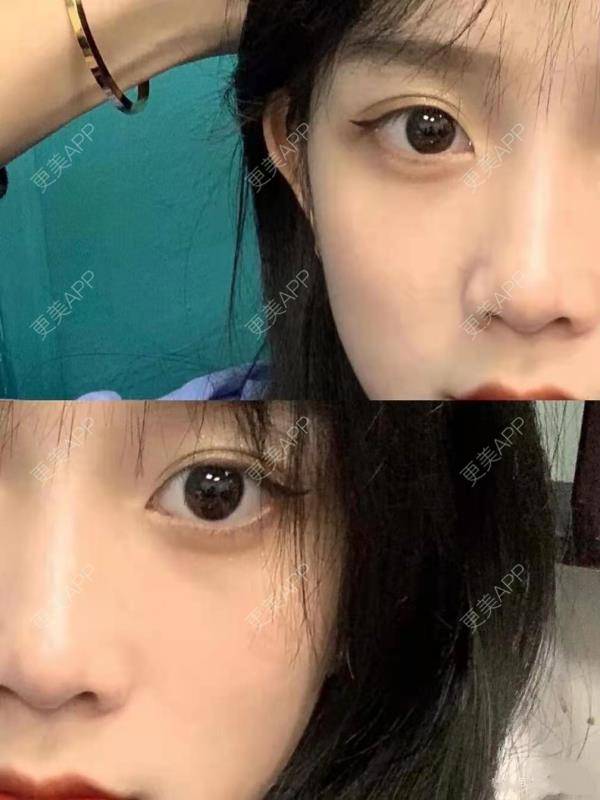 更美 - 可可丫！的双眼皮经验 | 双眼皮 | 双眼皮修复