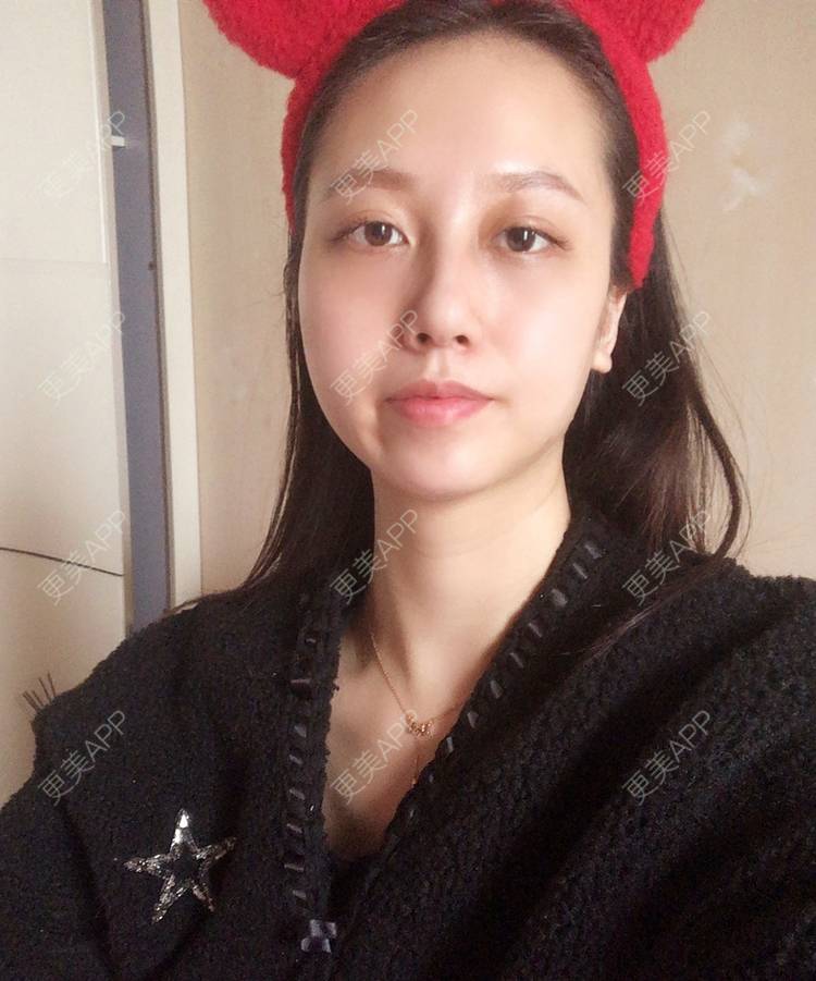 更美 - 祈祷鳄鱼的外切去眼袋经验 | 外切去眼袋 | 眶隔脂肪释放