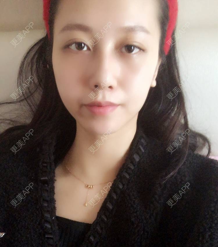 更美 - 祈祷鳄鱼的外切去眼袋经验 | 外切去眼袋 | 眶隔脂肪释放