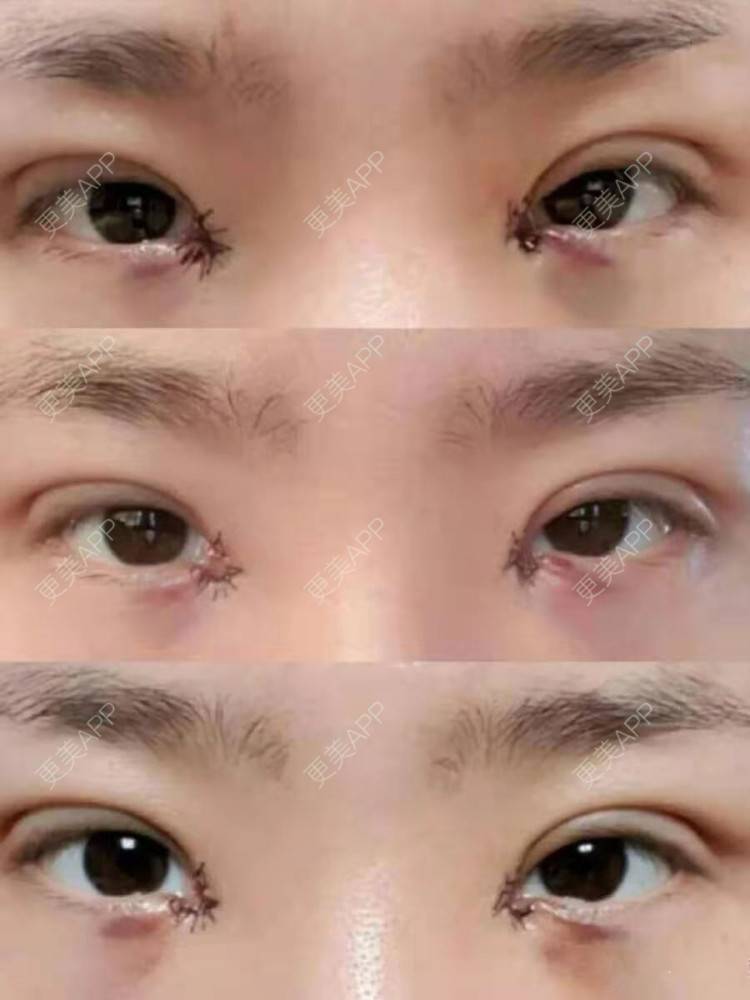 更美 - THe贤寳的双眼皮经验 | 双眼皮 | 双眼皮修复 | 临沂