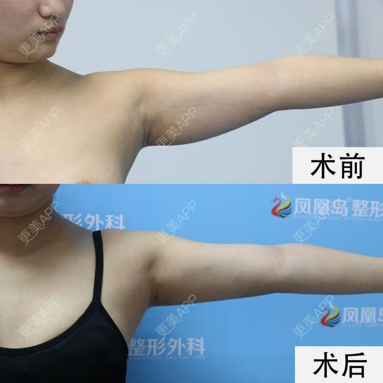 更美 - 更美用户vAGReTRuol的光纤溶脂瘦手臂经验 | 光纤溶脂瘦手臂 | 南京