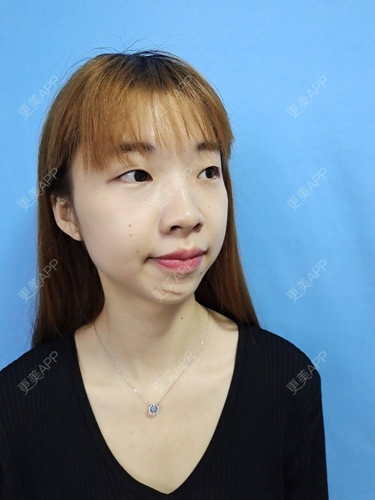 更美 - 痞子夺位比的激光淡疤经验 | 皮肤综合管理套餐 | 皮肤检测 | 激光淡疤 | 成都