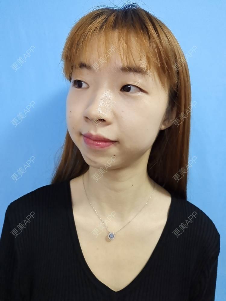 更美 - 痞子夺位比的激光淡疤经验 | 皮肤综合管理套餐 | 皮肤检测 | 激光淡疤 | 成都