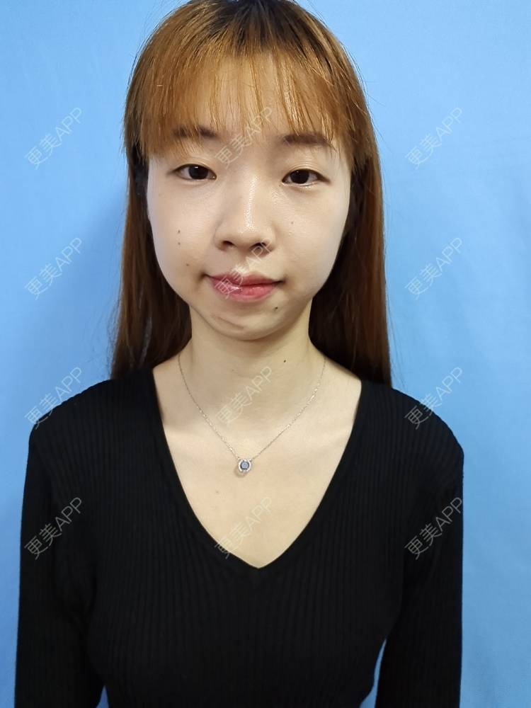 更美 - 痞子夺位比的激光淡疤经验 | 皮肤综合管理套餐 | 皮肤检测 | 激光淡疤 | 成都