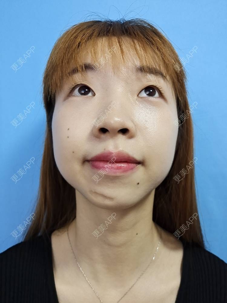 更美 - 痞子夺位比的激光淡疤经验 | 皮肤综合管理套餐 | 皮肤检测 | 激光淡疤 | 成都