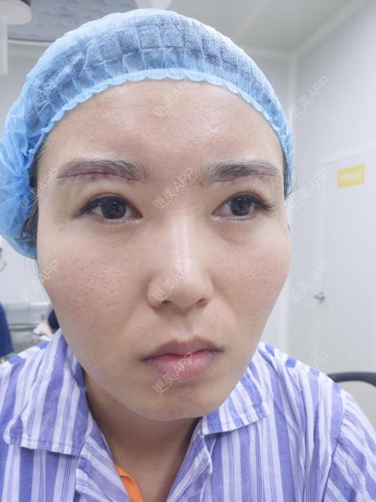 更美 - blinglee的切眉经验 | 切眉 | 深圳