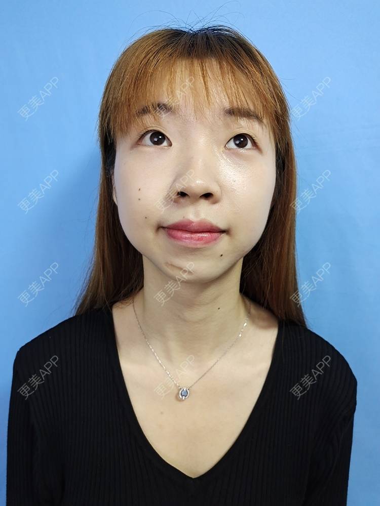 更美 - 痞子夺位比的激光淡疤经验 | 皮肤综合管理套餐 | 皮肤检测 | 激光淡疤 | 成都