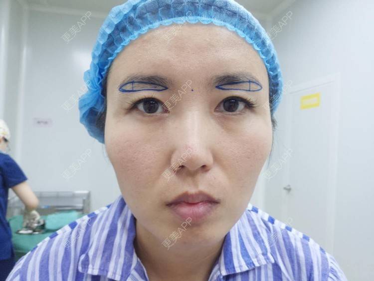 更美 - blinglee的切眉经验 | 切眉 | 深圳