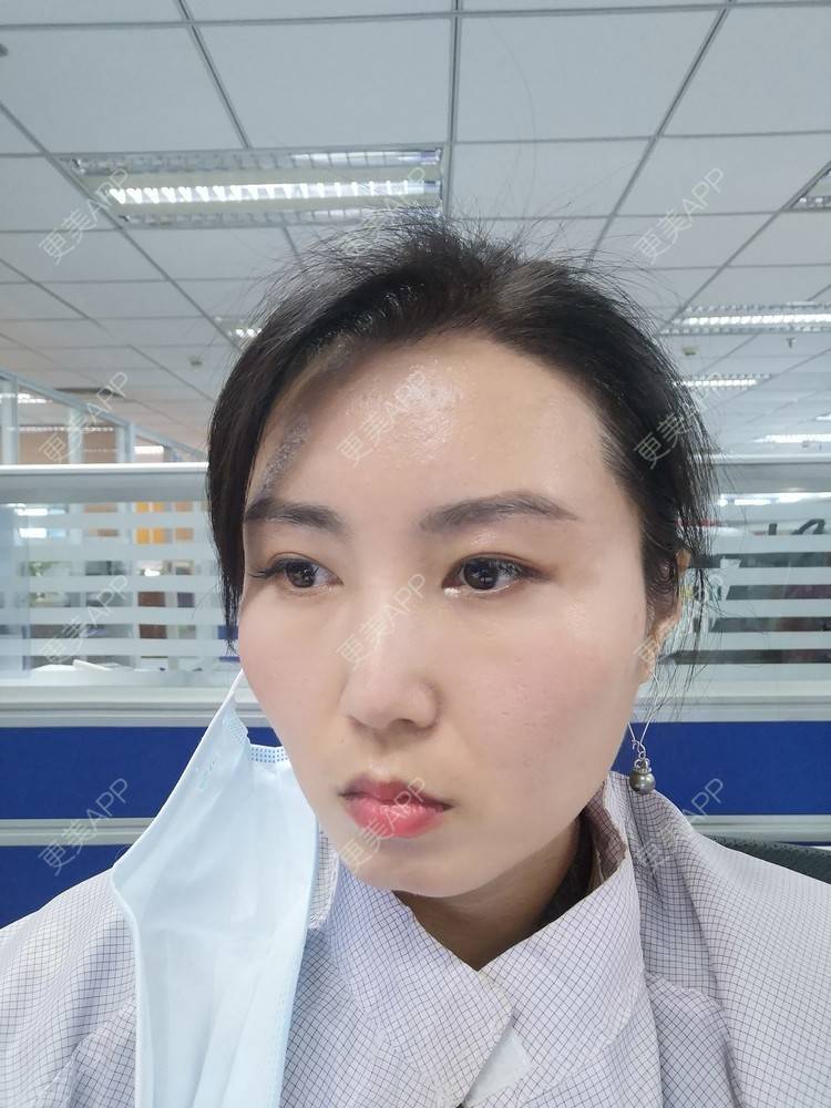 更美 - blinglee的切眉经验 | 切眉 | 深圳