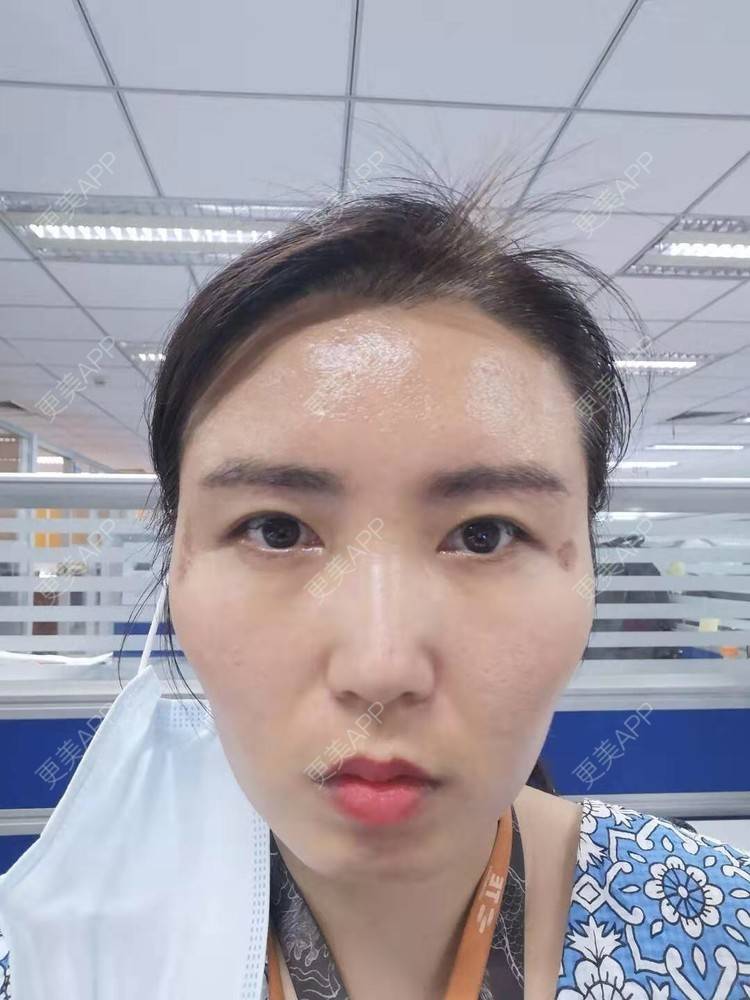 更美 - blinglee的切眉经验 | 切眉 | 深圳