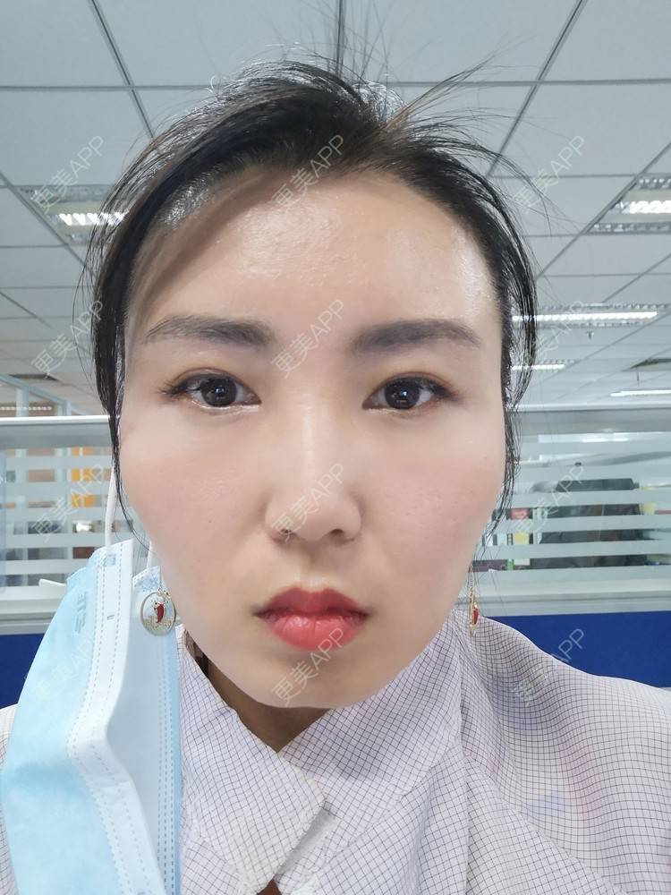 更美 - blinglee的切眉经验 | 切眉 | 深圳