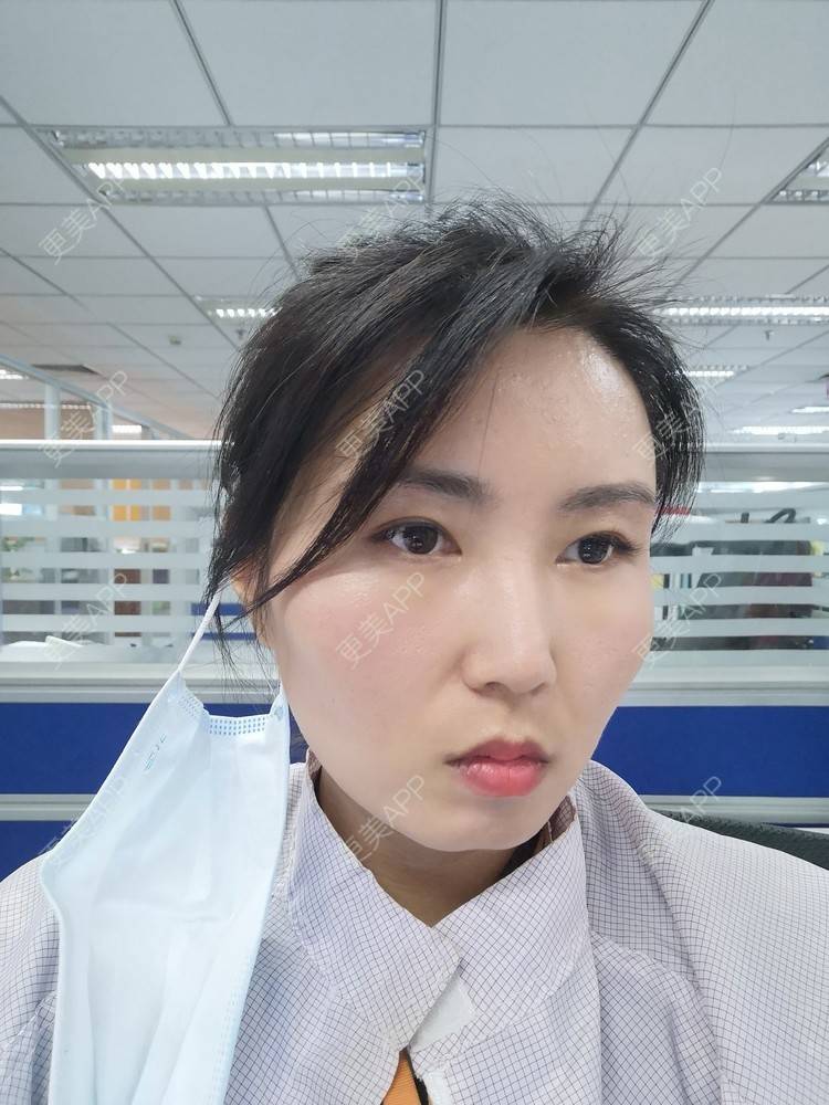 更美 - blinglee的切眉经验 | 切眉 | 深圳